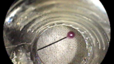 Thiếu nữ ngồi thêu tranh lỡ nuốt kim khâu vào bụng