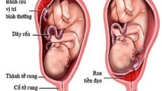 Dây rốn quấn cổ có thể khiến cướp sinh mạng bé khi chưa chào đời