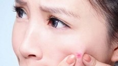 Bạn sẽ ngạc nhiên với cách trị mụn đơn giản mà vô cùng hiệu quả