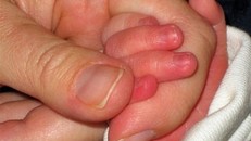 Cách phòng tránh và trị bệnh cước chân tay vào mùa đông