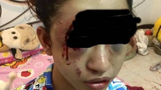 Vì bát cẩn cô gái bị trộm lẻn vào đánh 'nát' khuôn mặt 