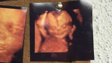 Lý giải những bức ảnh siêu âm thai nhi kì quái gây xôn xao