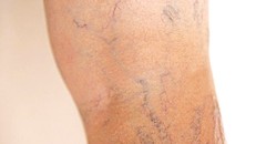 Chân xuất hiện nhiều gân xanh: Nguy cơ mắc bệnh nguy hiểm