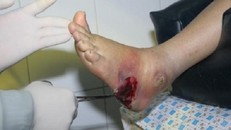 Cẩn thận với những biến chứng quái ác của bệnh tiểu đường