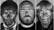 Bộ ảnh gây sốc về tác hại của ánh nắng mặt trời lên da người