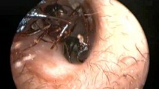 Kinh hoàng phát hiện hàng nghìn con kiến trong tai cô bé 12 tuổi