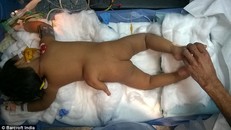 Kỳ lạ bé gái 2 tuổi mọc chân thứ 3 ở lưng