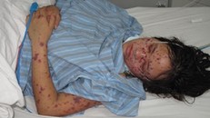 Theo dõi 50 người liên quan vụ nữ sinh tử vong do viêm não mô cầu