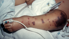 Bệnh viêm màng não mô cầu và những điều 'nhất định phải biết'