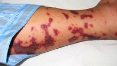 Dịch bệnh nguy hiểm viêm màng não mô cầu và cách phòng bệnh