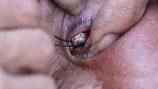 Bác sĩ bó tay vì cụ bà mắc bệnh ‘nước mắt hóa đá’