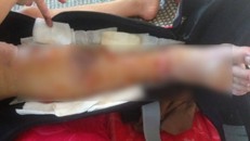 Đắk Lắk: Nữ sinh xinh xắn, học giỏi mất chân vì bác sĩ tắc trách