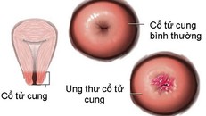 Ung thư cổ tử cung và 'tất tật' những điều cần biết