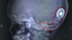 Thanh âm đầu đời của cô bé nghèo 7 năm sống trong thinh lặng