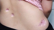 Bệnh nhân bị các vết lõm sâu sau khi điều trị sẹo lồi tại một thẩm mỹ viện ở Hà Nội. Ảnh: BS cung cấp.