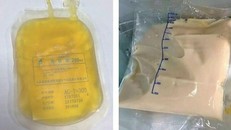 Bác sĩ giật mình khi máu bệnh nhân có lớp váng như mỡ, do ăn những món ai cũng thích