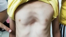 Bé trai bị lõm ngực nặng. Ảnh: N.D