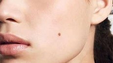 Ung thư từ nốt ruồi là loại rất nguy hiểm, phát triển nhanh, di căn nhanh, gây ung thư thứ phát ở gan, xương, phổi, não, hệ thống hạch...Ảnh minh hoạ: Internet