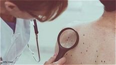 Ung thư da cướp đi sinh mạng nhiều đàn ông