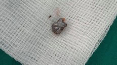 Viên đạn được gắp ra khỏi cơ thể bé trai. Ảnh bệnh viện cung cấp.