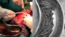 Chuyện khó tin: người đàn ông nuốt 116 chiếc đinh nhọn vào bụng
