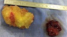 Hai khối u kích thước lớn di động trong tim của bệnh nhân. (Ảnh: Lê Xuân/TTXVN)