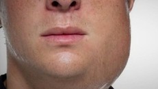 Bệnh quai bị - Hình minh họa: Internet