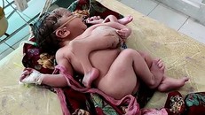 Bé gái có 4 chân và 3 tay do dính liền với một thai nhi khác.
