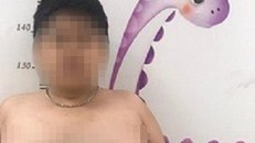 Bé trai rậm lông, ngực nở như con gái vì lạm dụng thuốc corticoid