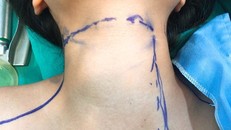 Mổ tuyến giáp bằng dao siêu âm mang lại nhiều hiệu quả điều trị