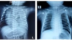 Hình ảnh chụp X-quang của bé trai sau ca phẫu thuật thành công bằng phương pháp thắt ống ngực.