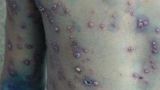 Nguy cơ bệnh thủy đậu tăng nhanh sau Tết