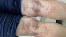 Bệnh viêm da tiếp xúc là các mảng ban đỏ tại vùng tiếp xúc, mụn nước, cảm giác châm chích, bỏng rát và đau nhức.