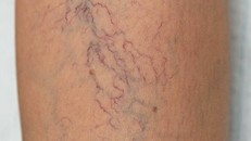 Biểu hiện giãn tĩnh mach. Ảnh: BV