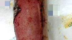 Tổn thương bỏng rất nặng ở bệnh nhân tự ý điều trị.