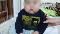 Bệnh nhi bị hội chứng cushing - suy tuyến thượng thận khiến mặt phù nề, tròn to như trái bí đỏ do sử dụng phải loại thuốc có chứa corticoid.