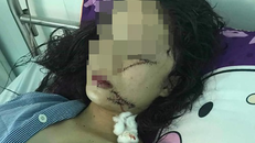 Sau khi bị rạch mặt và phải khâu tới 60 mũi, dung nhan của cô gái gần như bị huỷ hoại hoàn toàn