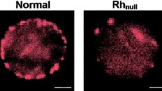 Hình ảnh so sánh giữa một tế bào hồng cầu bình thường và một tế bào hồng cầu của người nhóm máu Rh-null. Ảnh: Blood Journal