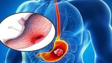 Hình ảnh ung thư dạ dày.