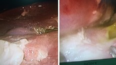 Hình ảnh lỗ thủng và giả mạc