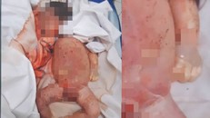 Trẻ sơ sinh tử vong với vết đứt trên cổ