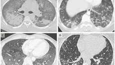 Hình ảnh scan phổi của 4 bệnh nhân tuổi từ 19 đến 49, cho thấy dấu hiệu tổn thương do sử dụng thuốc lá điện tử. Ảnh: New England Journal of Medicine.