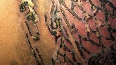 Tổn thương của bệnh nhân sau khi xóa xăm.