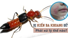 Lời khuyên của bác sĩ khi bị kiến ba khoang đốt