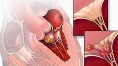 Viêm cơ tim cũng có thể do chính hệ miễn dịch tấn công gây ra
