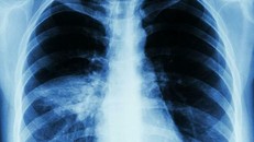 Viêm phổi là bệnh nguy hiểm, có thể dẫn tới tử vong. Ảnh: News.Virginia