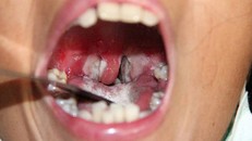 Bệnh bạch hầu có thể phòng ngừa bằng cách tiêm vắc xin. (Ảnh minh hoạ)