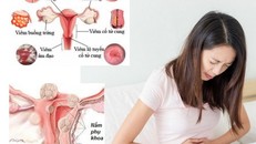 Bệnh phụ khoa gây ảnh hưởng trực tiếp đến sức khỏe của phụ nữ, đặc biệt đối với sức khỏe sinh sản. (Ảnh minh hoạ)