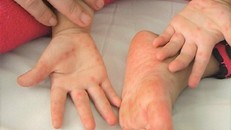 Bệnh tay chân miệng là bệnh truyền nhiễm cấp tính, chủ yếu xảy ra ở trẻ dưới 5 tuổi. Cho đến nay, bệnh vẫn chưa có vaccine dự phòng. 