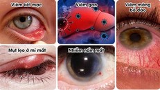 Các loại nhiễm trùng mắt thường gặp.